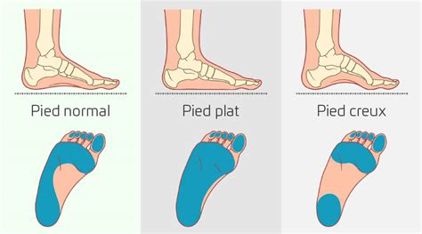 Pharynx Perspective Plan douleur au plat du pied la violence née sur