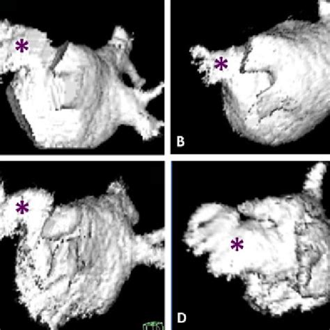 (PDF) Left Atrial Appendage Morphology in Patients with Non-Valvular ...