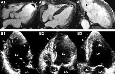 Detection Of Left Ventricular Thrombus By Cardiac Magnetic Resonance In Embolic Stroke Of