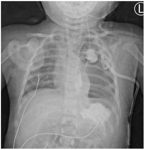 Esophageal Perforation With The Contrast Leak Contained In Left Focal