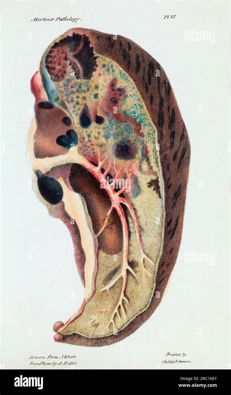 Lung infected with tuberculosis, 19th century illustration Stock Photo - Alamy