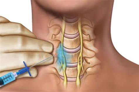 Stellate-Ganglion Block - Pain management clinics in Las Vegas | Nevada Comprehensive Pain Center