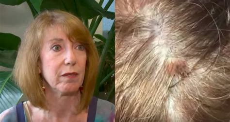 Womans Hairstylist Noticed A Deadly Mole On Clients Scalp