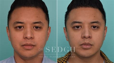 Chin Augmentation Before And After Photos Dr Sedgh