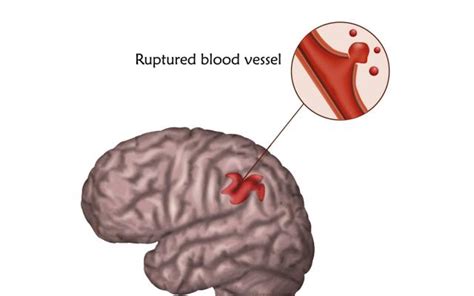 Acv Hemorrágico Cómo Reconocer El Ictus Hemorrágico Bupa