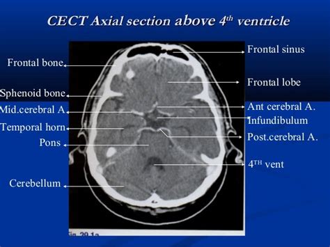 Radiological Anatomy And Techniques Of The Ventricular System