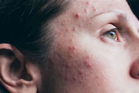 Acne Vulgaris Causes