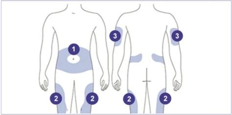 Insulin Injection Sites Diagram For Patients