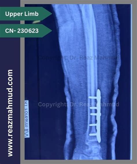 Distal Ulna Fracture ORIF CN 220907 Dr Reaz Mahmud