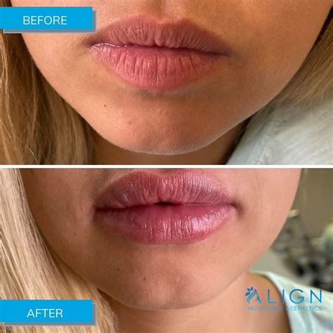 Before After Results Align Injectable Aesthetics