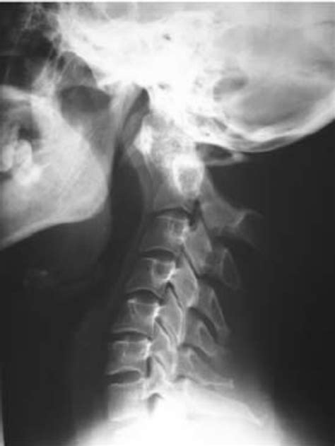 Cervical Spine Subluxation