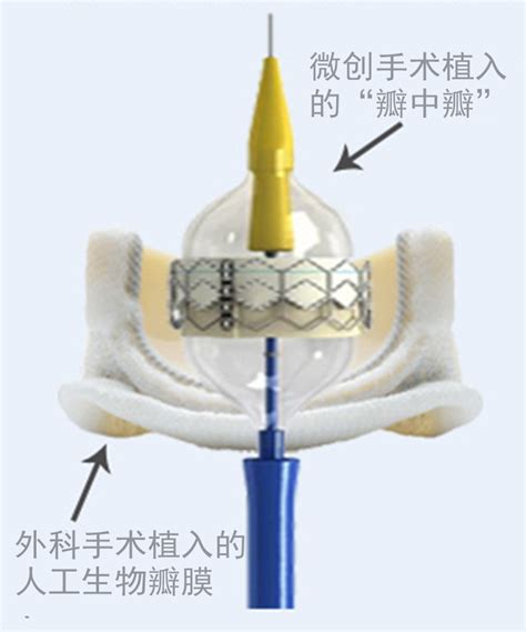 换瓣术后高龄患者再发病 微创介入“瓣中瓣”手术送福音