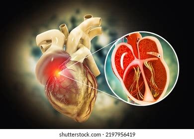 Stent Angioplasty Procedure On Medical Background3d Stock Illustration ...