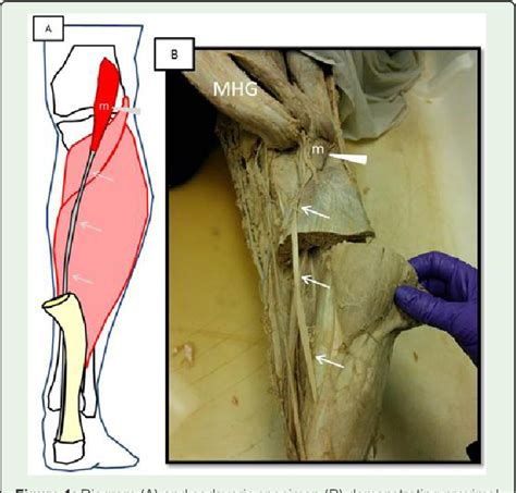 Figure From Mri Evaluation Of Calf Hematoma Frequency Of Plantaris