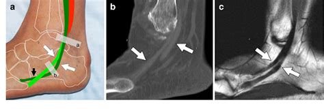 Peroneus Longus Tendon Tear