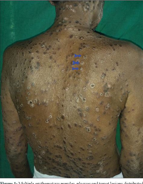 Figure From Generalized Lichen Planus Developing At The Healed Sites