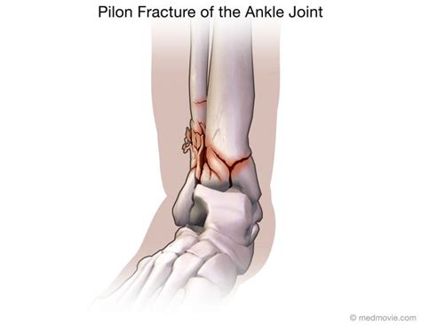 Pilon Fracture Of The Ankle Joint