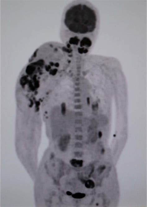 Positron Emission Tomography Computed Tomography Pet Ct High