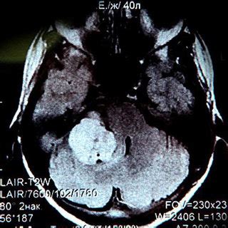 The T1 Weighted Contrast Enhanced MR Image Taken After The Surgery