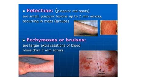 Idiopathic Thrombocytopenic Purpura Ppt