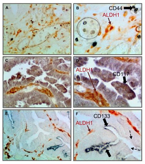 Aldh1 And Cancer Stem Cell Csc Markers Are Expressed In Different