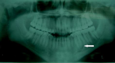 Osteoid Osteoma Associated With The Teeth Unusual Presentation