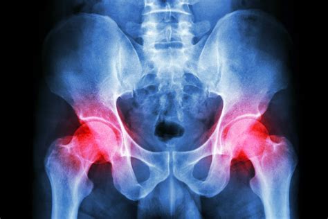 Hip Arthritis Orthopedic Institute Of Sioux Falls