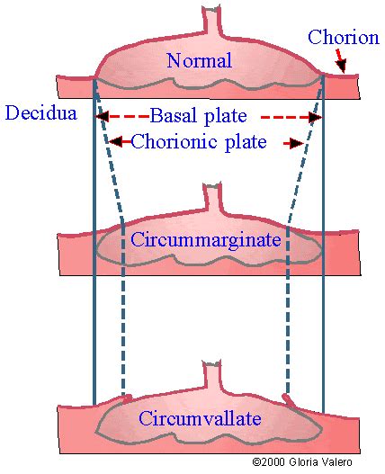 📃 Placenta Circumvallate