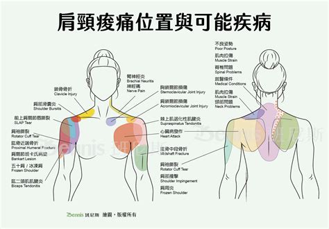 肩頸痠痛原因？急性痠痛舒緩3招，7個生活習慣改變更有效 床墊、睡眠與家具，班尼斯提供科學、設計的全面深入報導