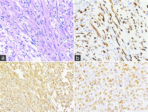 A And B Inflammatory Myofibroblastic Tumors The Tumor Is Composed