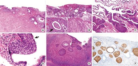 Squamous Cell Carcinoma In Situ With Glandular Extension Of The Uterine Download Scientific