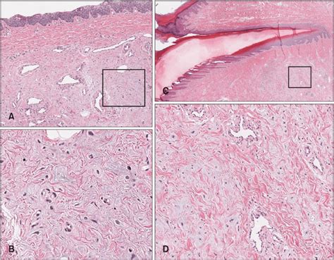 Hematoxylin And Eosin Hande Staining Of Biopsy Specimens Includeing