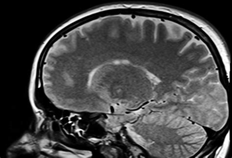 Scientists detect early Alzheimer’s with just one brain scan | Courthouse News Service