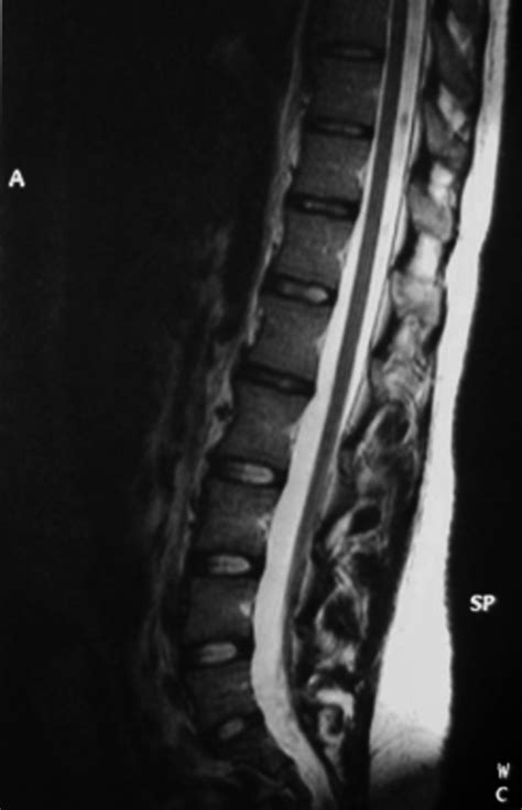Irm Lombaire En Coupe Sagittale T Montrant La Moelle Bas Ins R E