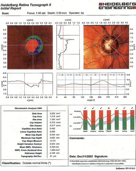 Glaucoma Toronto Eye Clinic Eye Doctors Toronto Optometrists And