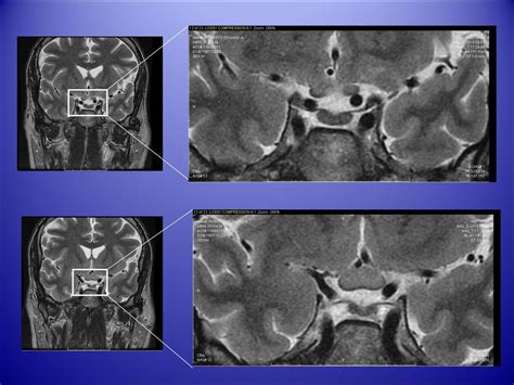 Non-Syndromic Optic Chiasm Mass in an Adult - ppt download