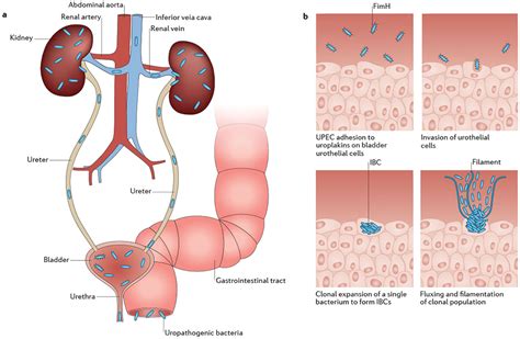 Urinary Tract Infection Causes Symptoms Diagnosis Prevention Treatment