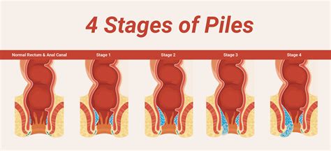 External Hemorrhoids Grading Scale at Hilda Brown blog