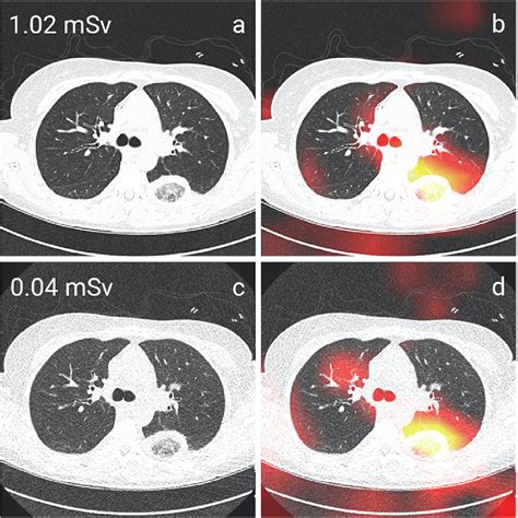 Pneumonia Detection In Chest X Ray Dose Equivalent Ct Impact Of Dose