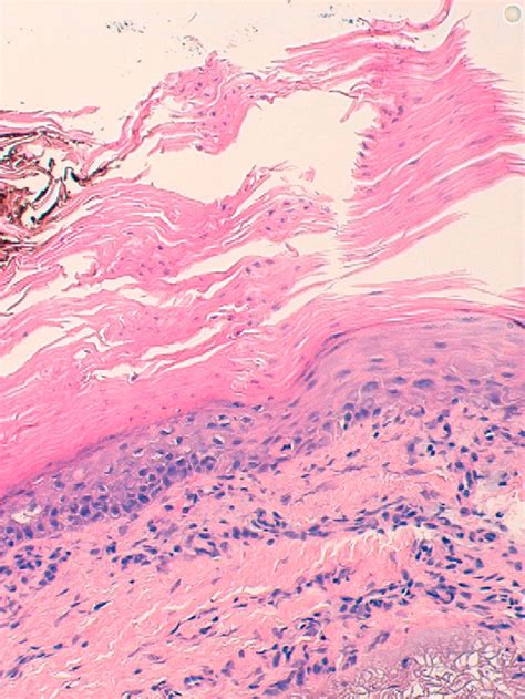 Porokeratosis of Mibelli: A New Indication for Photodynamic Therapy