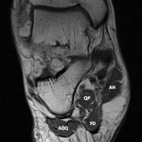 Foot Muscles Mri : Normal Foot Mri Radiology Case Radiopaedia Org - The muscles lie within a ...