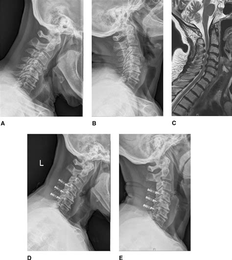 Cervical Laminoplasty Indications Surgical Considerations Jaaos