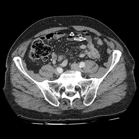 An Additional Contrast Enhanced Portal Venous Phase Axial Ct