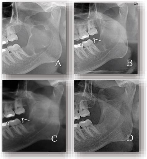 Figure From Conservative Management Of Keratocystic Odontogenic Tumor