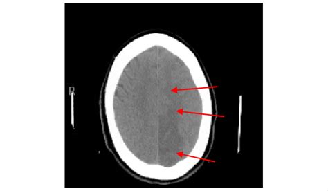 Ct Head Showing Low Attenuation Areas Of Infarction Involving Download Scientific Diagram