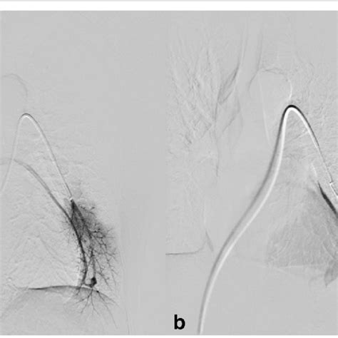 A Baseline Pulmonary Digital Subtraction Angiography In A 52 Year Old