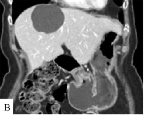 Cystic Neoplasms Of The Liver Biliary Cystadenoma And