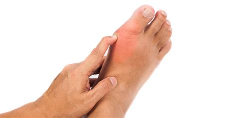 5 Symptoms Of Foot Gout Rnv Podiatry