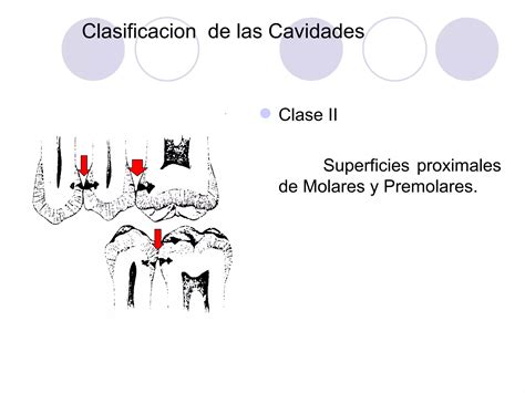 Tema 05 Nomenclatura Y Clasificacion De Las Cavidades PPT