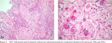 Squamous cell carcinoma of the stomach